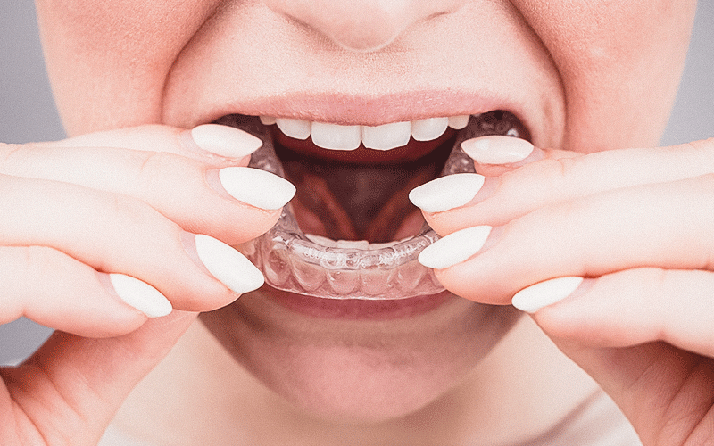 O bruxismo não é uma doença, mas é um fator de risco para disfunções temporomandibulares, danos dentários e dores musculares